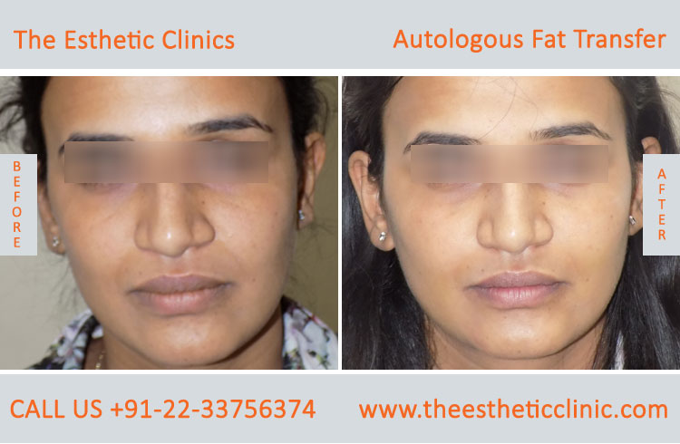 Autologous Fat Transfer, Fat Transfer Grafting, Lipofilling Fat Transfer Surgery before after photos (1 (3)